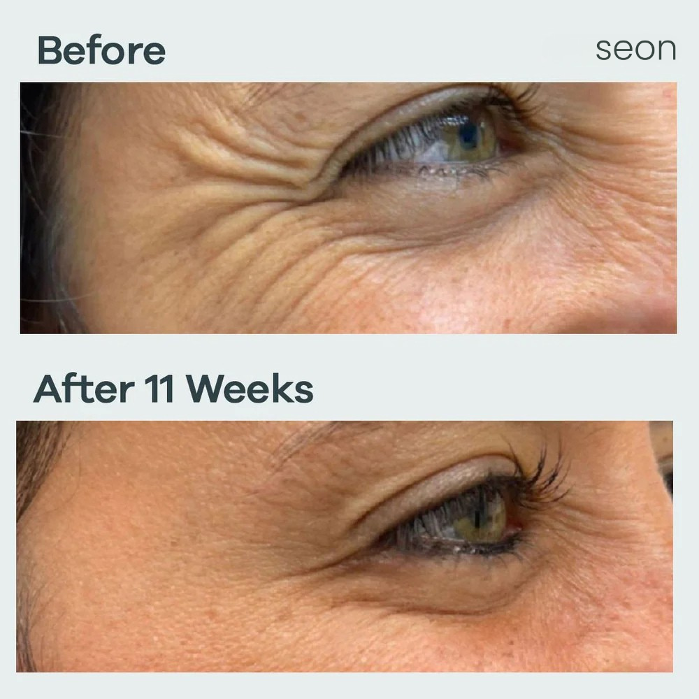 Eye NovaLift - Micro infusion patches