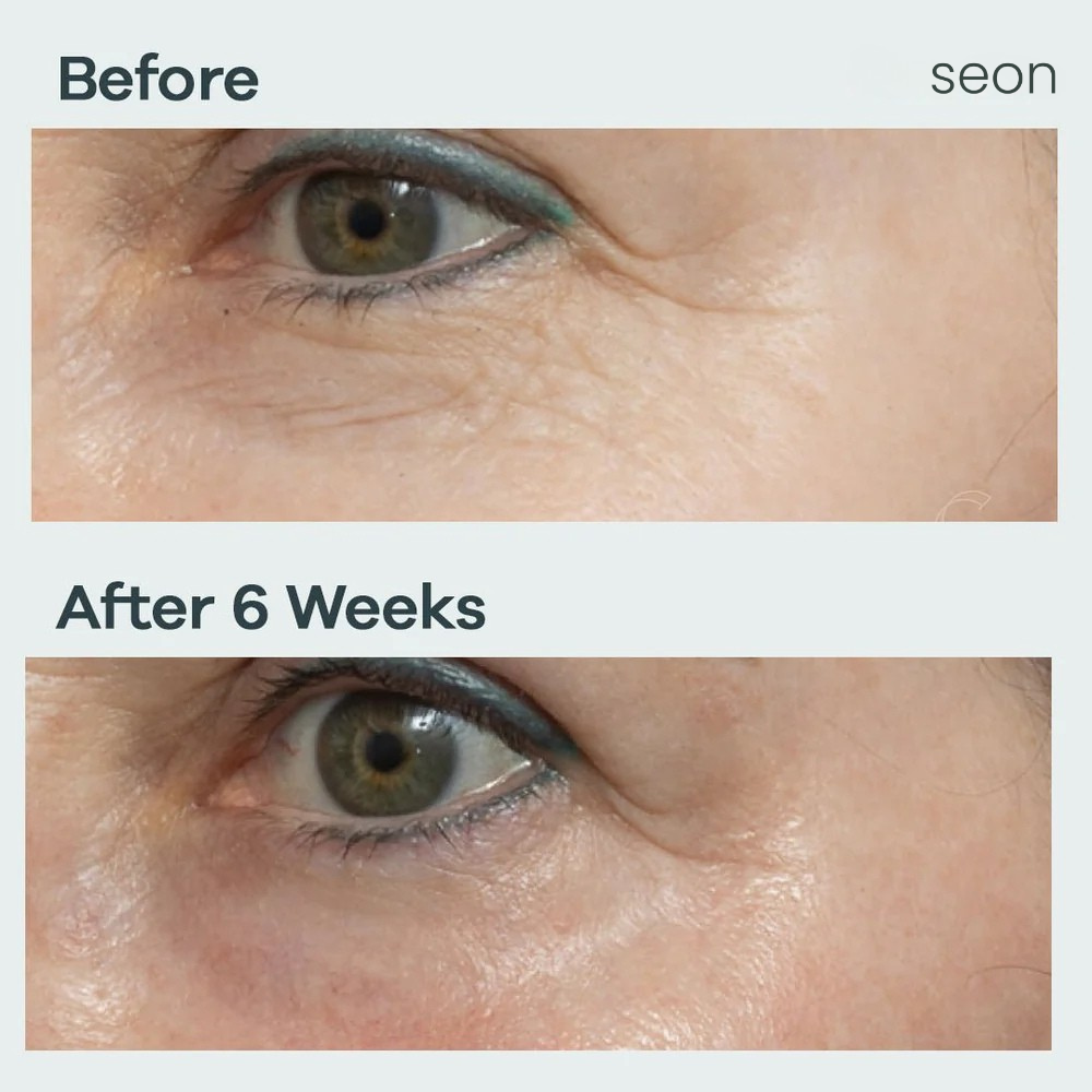 Eye NovaLift - Micro infusion patches